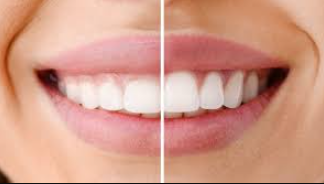 The GUMS Procedure: A Promising Solution To An Unsightly Problem