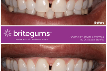 Gum Lightening: A Painful And Ineffective Solution To Gum Pigmentation